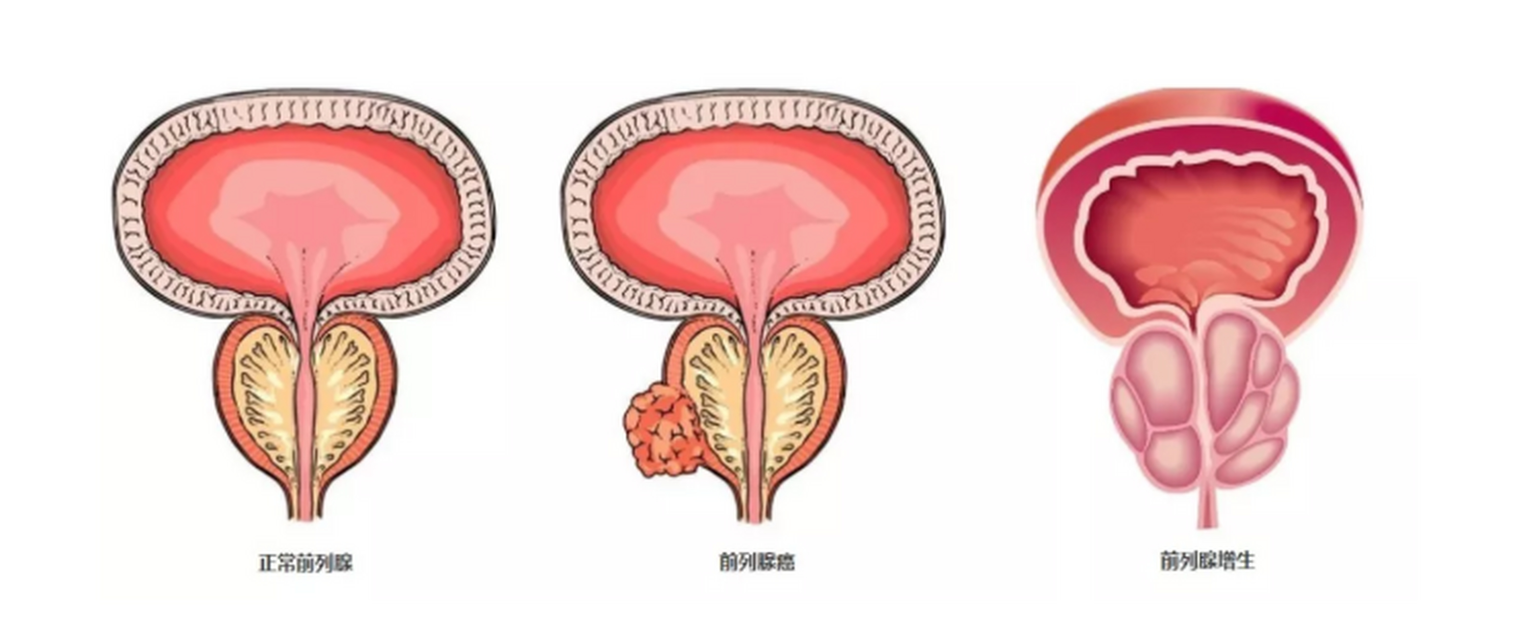 培米替尼（Pemigatinib）能用于尿路上皮癌吗？