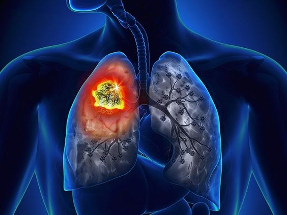 赛普替尼（RETEVMO）：精准狙击RET融合阳性NSCLC，重塑治疗格局