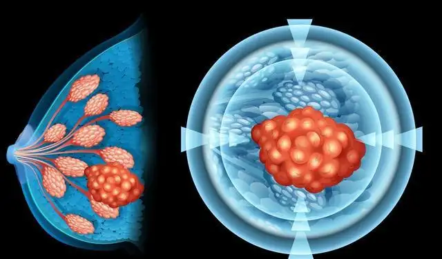 卡帕塞替尼：乳腺癌治疗领域的精准打击新星